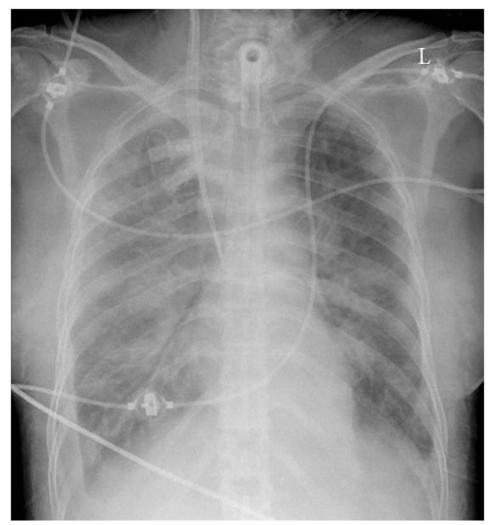Chest X Ray, CXR, Deep Learning, CheXNet, n2value, tracheostomy, infiltrates, pulmonary edema